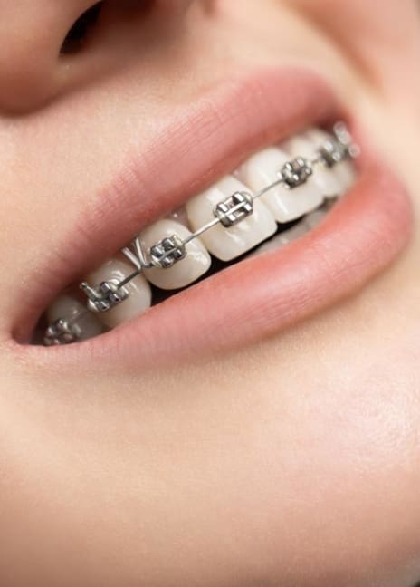 Manningtree Dental - Fixed Braces