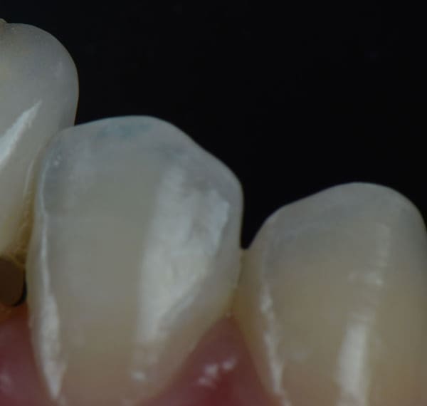 Crowded Teeth - Manningtree Dental