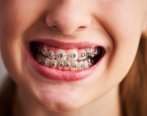 Braces Care Tips
