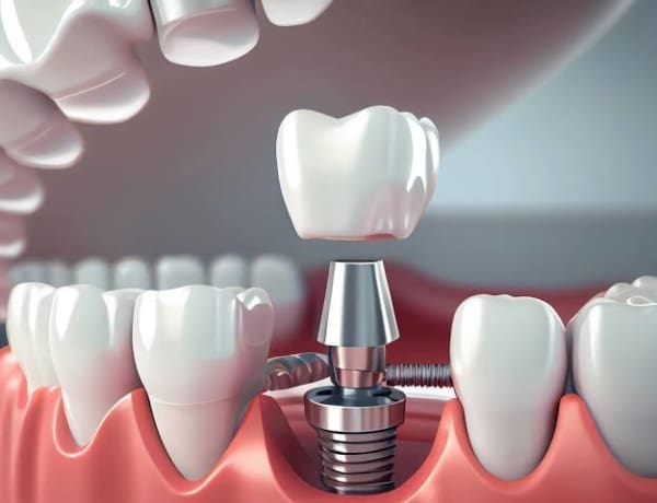 Root Canal Treatment